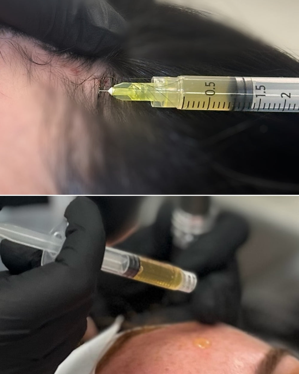 Platelet Rich Plasma (PRP) & Phlebotomy Course - No Kit