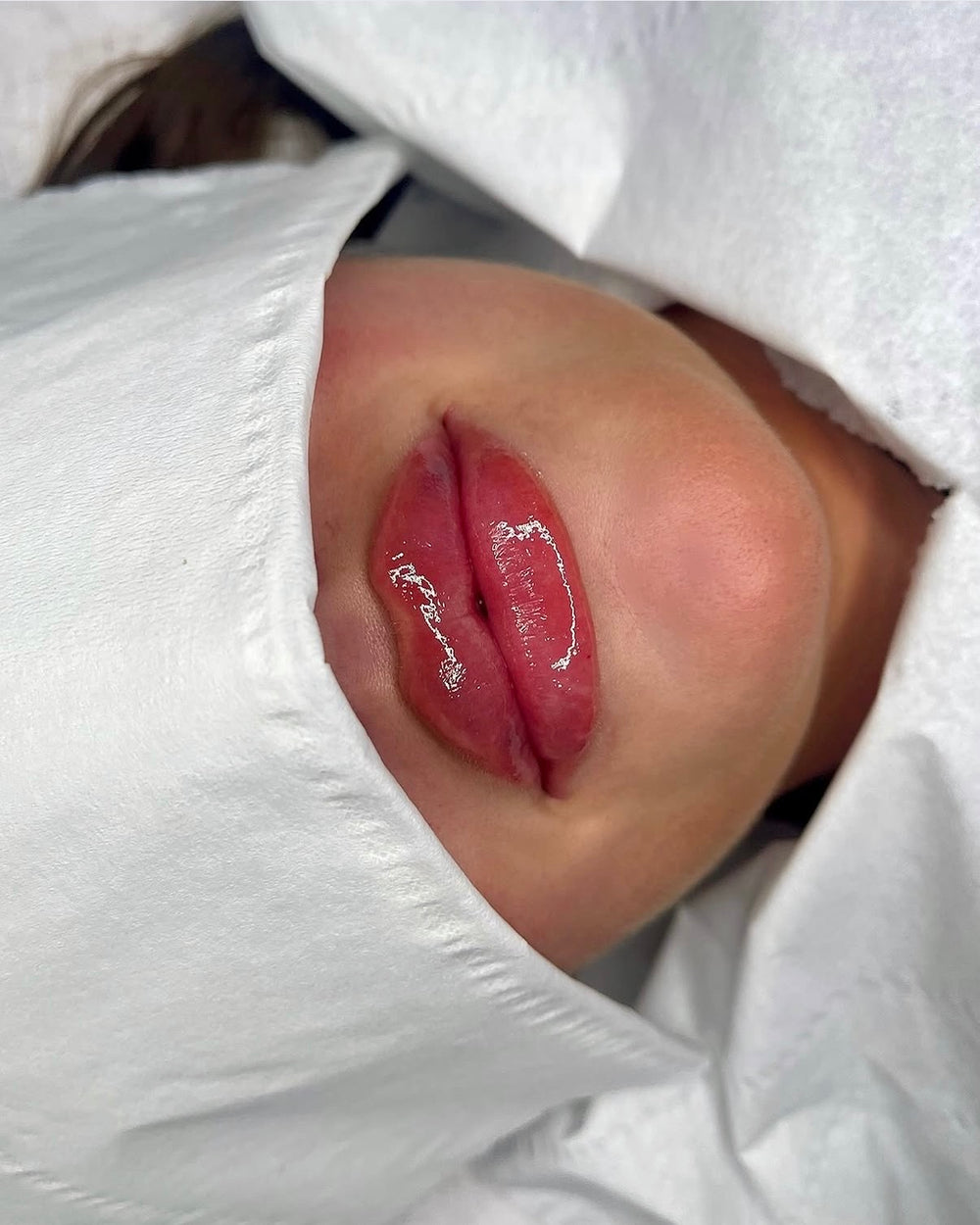 Advanced HA Dermal Filler Course