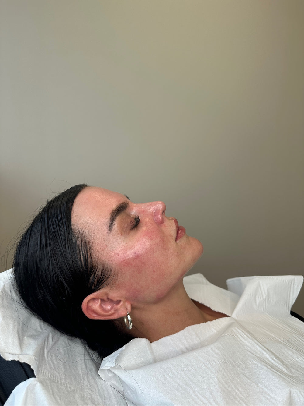 HA Dermal Filler Advanced Course