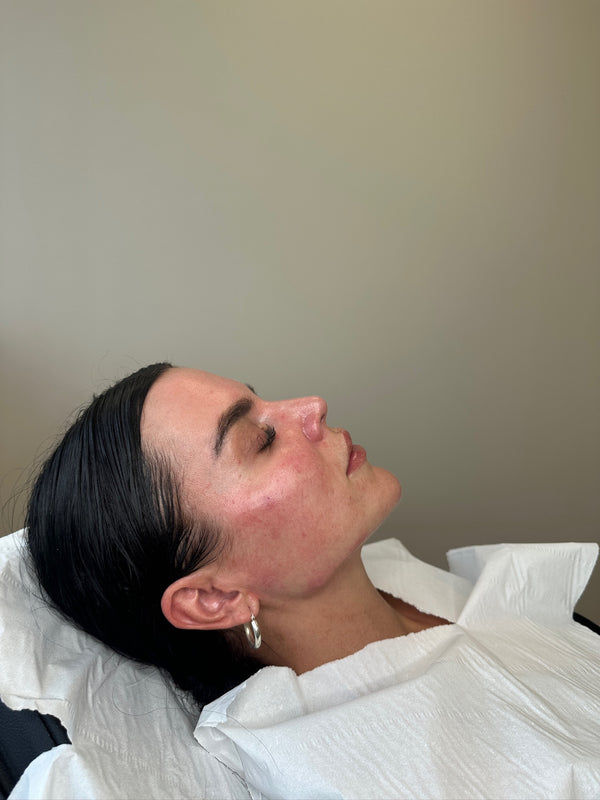 HA Dermal Filler Advanced Course